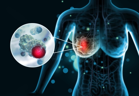 Liệu pháp kháng thuốc cho ung thư vú âm tính ba lần